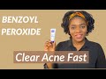 Acne Treatment - How to use BENZOYL PEROXIDE for ACNE | Dr Janet