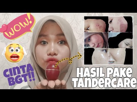 Punya kulit berminyak dan noda bekas jerawat? .... Kamu gak perlu khawatir lagi sekarang dengan miny. 