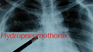 hydropneumothorax