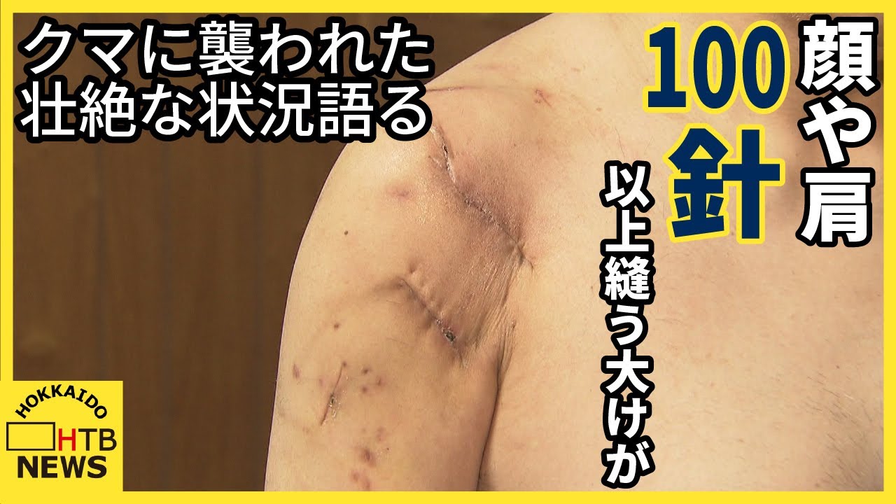爪が顔を貫通」壮絶な状況語る 釣りの帰りにクマに襲われ…男性が顔や肩 