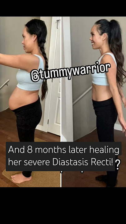 Healing Severe Diastasis Recti without surgery, don't lose hope!! 💕