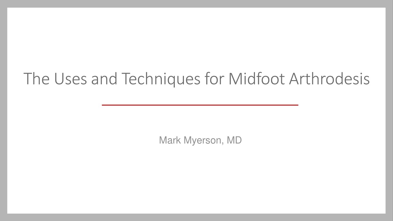 Arthrodesis of the Midfoot YouTube