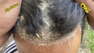 DRY SCALP !! Big Flakes Dandruff Scratching Satisfying Video #868