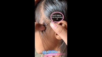 (Part 08) Lice Removal & Treatment  Satisfying Lice Popping