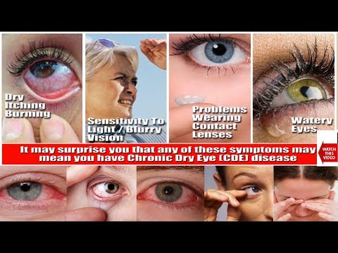 सूखी आंख सिंड्रोम | मराठी | MARATHI | मरीजों को शिक्षा और सूचना | कारण, लक्षण, उपचार।
