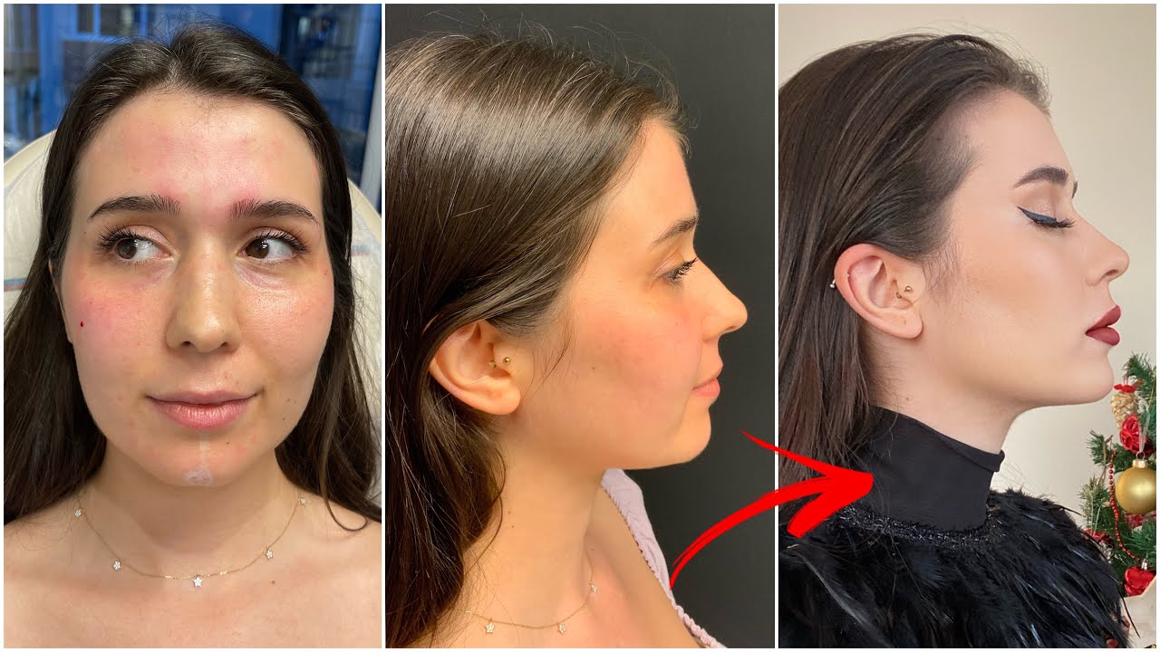 İLK KEZ ESTETİK YAPTIRDIM 💉| dudak, çene, burun ve göz altı ışık dolgusu & botoks ❤️