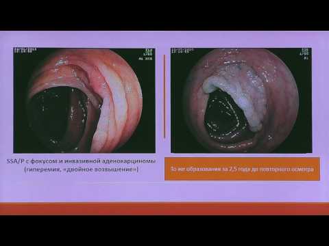 05 Агапов МЮ Зубчатые аденомы Проблемы эндоскопической диагностики