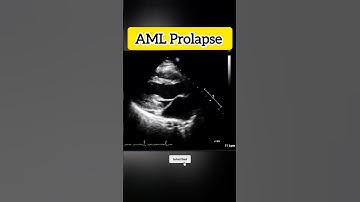 Anterior Mitral Valve Leaflet Prolapse