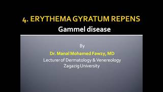 Figurate erythema (4- erythema gyratum repens)