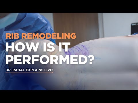 Expert Guide To Modern Rib Remodeling Surgery Performed By Dr William Rahal Beverly Hills CA