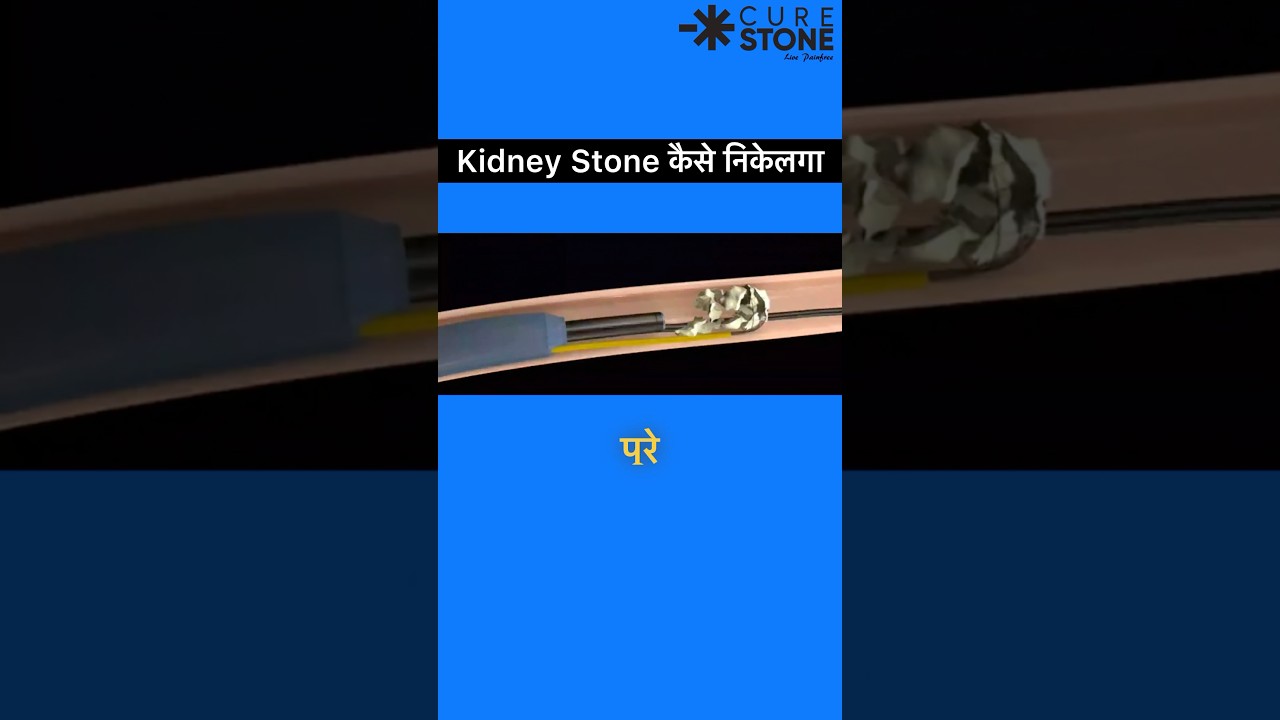 How Ureteric stones are removed | Ursl animation | Laser treatment | rirs