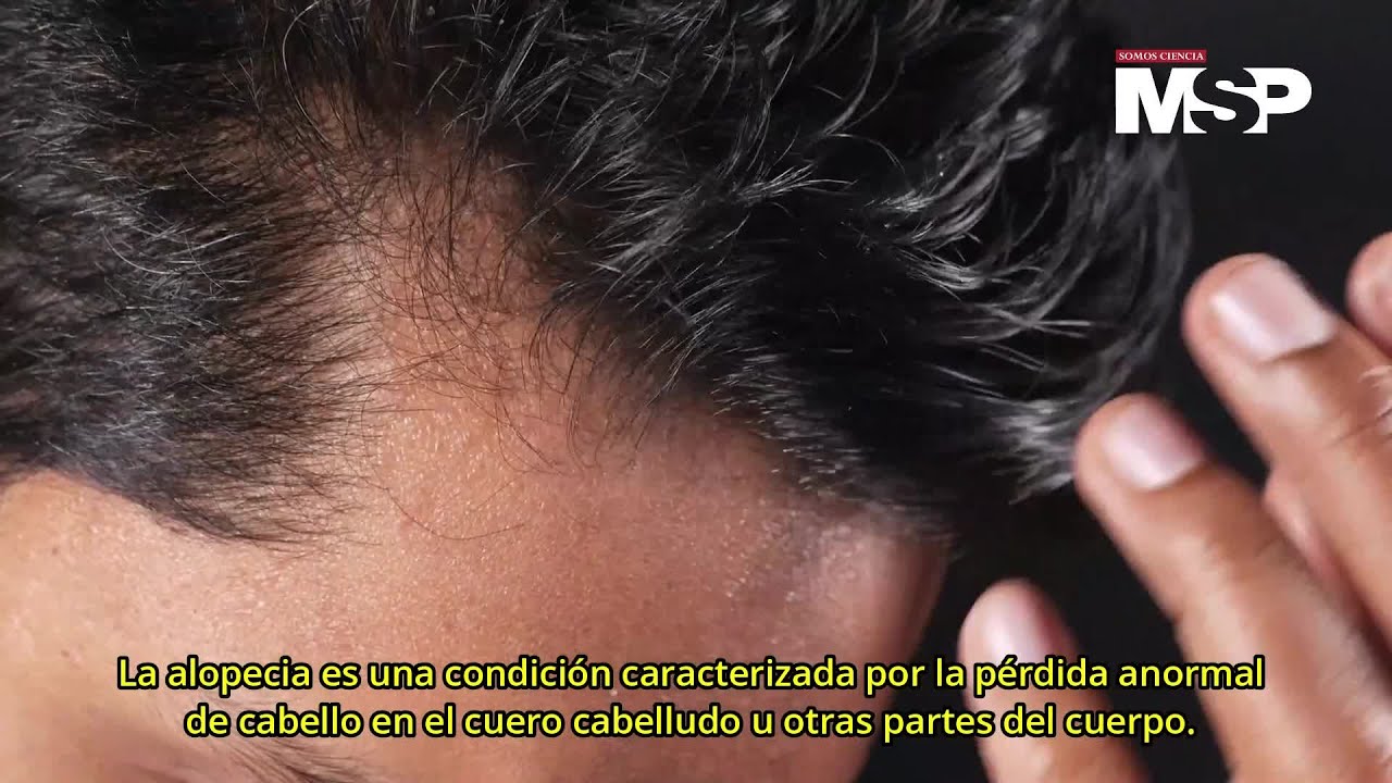 cinco-tipos-de-alopecia-exclusivomsp-youtube