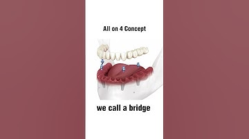 Learn the All on 4 Implants Concept in 12 Secs!