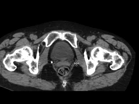 Papillary urothelial carcinoma