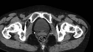 Papillary Urothelial Carcinoma