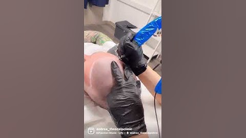 Scalp Micropigmentation For Male Pattern Baldness | The Scalp Clinic