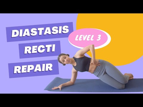 Diastasis Recti Repair