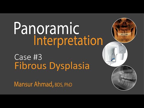Fibrous Dysplasia: Panoramic