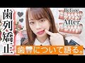 【歯列矯正】ガタガタ・出っ歯と言われた歯をついに矯正します。【費用・痛みetc..】