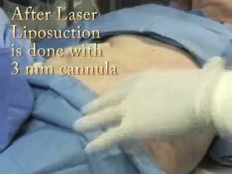 Laser Liposuction-Allu...  Charles Mok
