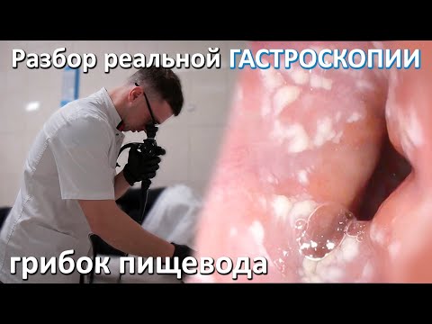 Грибок пищевода. Реальная гастроскопия, как проходит. последствия ковид 19