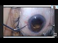 Bouquet of learning in cataract surgeries   dr  vipul arora