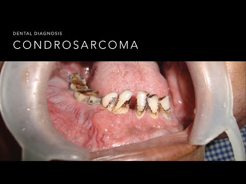 Vídeo: Càncer D'ossos (condrosarcoma) En Gats