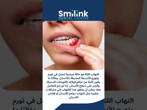 علاج التهاب اللثة حول الضرس في المنزل