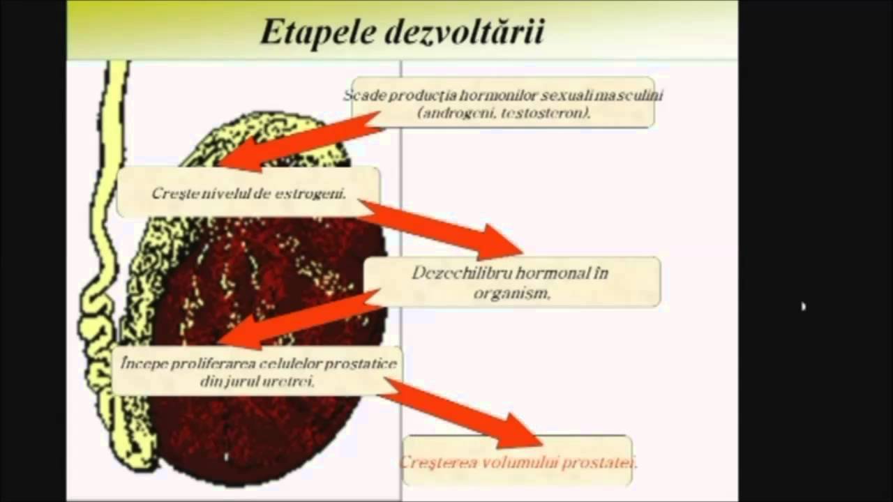 tratați prostatita o dată pentru totdeauna)