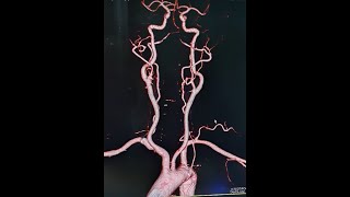 CT Carotid & Cereberal  Angio