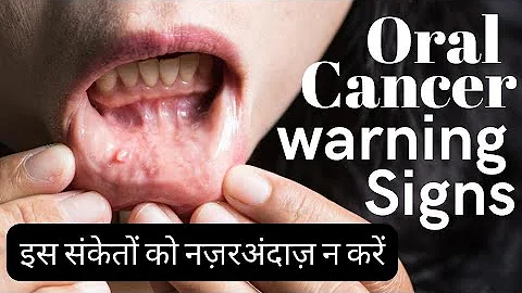 Mouth cancer symptoms in Hindi | early signs of oral cancer