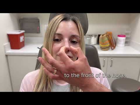Video thumbnail: Rhinoplasty for a dorsal hump & droopy tip | Anthony Bared MD, FACS | Miami, FL · Dr. Anthony Bared, M.D - Facial Plastic Surgeon