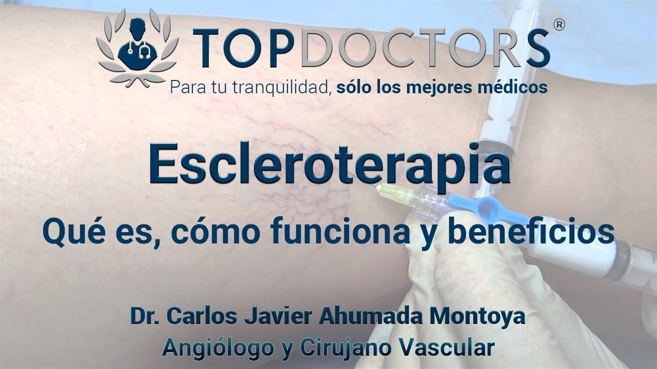¿Sabías que la escleroterapia es la mejor opción para las várices