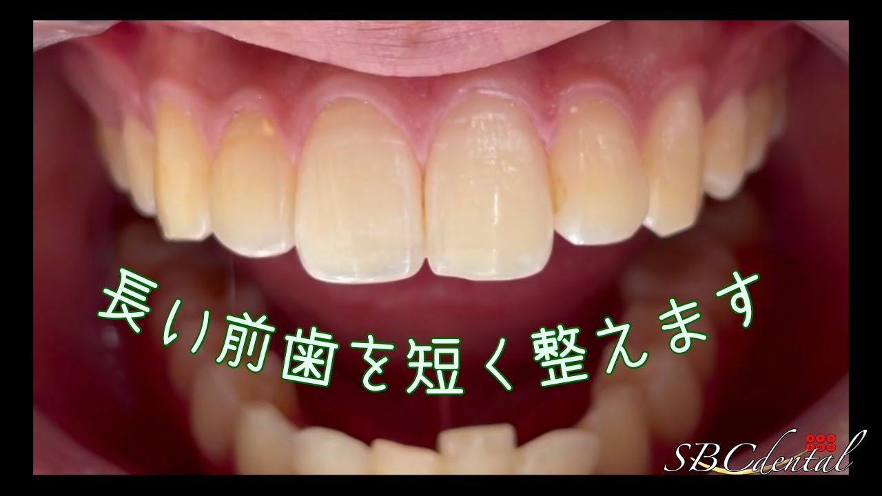 前歯 長い 削り たい