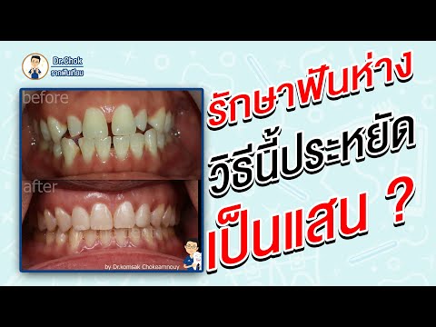 เคสฟันห่าง รักษาอย่างไร ให้ประหยัดเป็นแสน ?!! | Talk Case กับหมอโชค