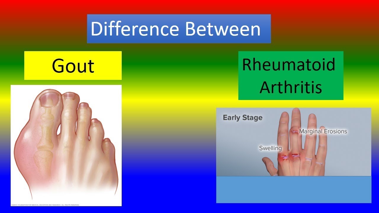 How Can You Tell The Difference Between Gout And Rheumatoid Arthritis?