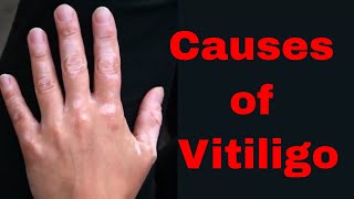 🖐🖐 Causes of Vitiligo | Vitiligo Skin Disease