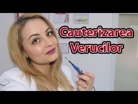 Video: 3 moduri de a elimina verucile faciale