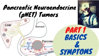 Pancreatic Neuroendocrine Tumor Part 1; Basics and Symptoms screenshot 5