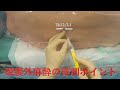 硬膜外麻酔穿刺ポイント Th12/L1 epidural anesthesia by Dr.EpiCal