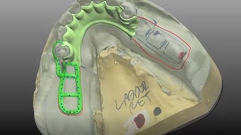 3shape CAD training how to create ladder retention on your RPDs-#8