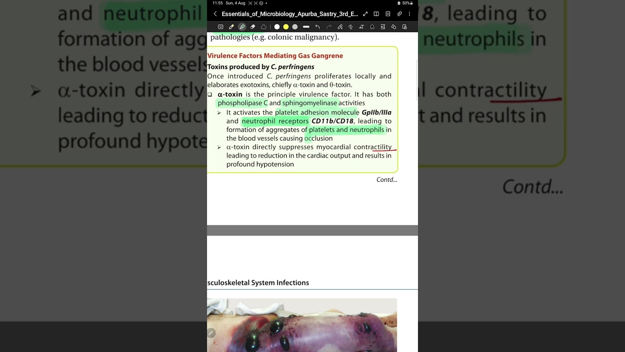 Alpha toxin Gas gangrene