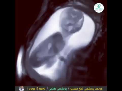 جوڵەی مناڵ لە سکی دایکیدا