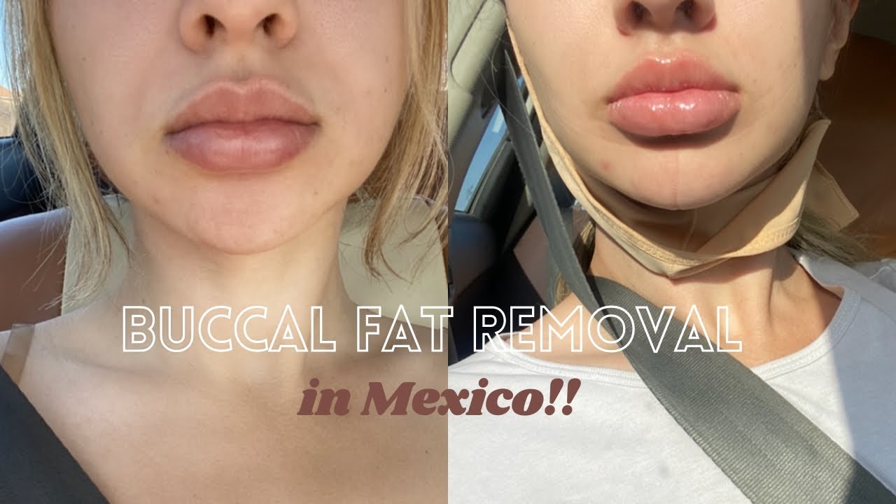 I GOT COSMETIC SURGERY IN MEXICO!!+ buccal fat removal Q&A YouTube