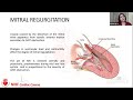 Hocm diagnosis  treatment nhf