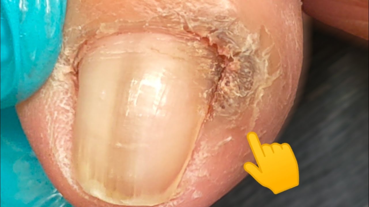 cutting out a foot wartkalugu hiding under a toenail YouTube