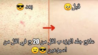 احسن علاج لجلد الوزه في اقل من اسبوعين هيعالجه تماما