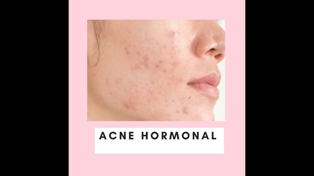 Acne Hormonal na mulher: como identificar e o que fazer