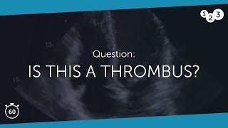 60 Seconds of Echo Teaching Question: A thrombus?