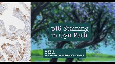 p16 in Gyn Path- Use and Interpretation